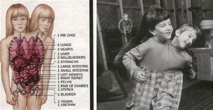 The Tragic End: Abby And Brittany Hensel's Unfortunate Fate