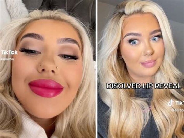Unbelievable! The Horrifying Case Of A Botched Lip Filler Nightmare