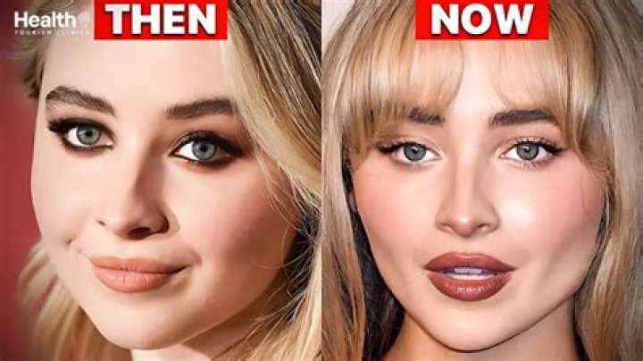 Uncovering The Truth: Did Sabrina Carpenter Get Facial Injections?