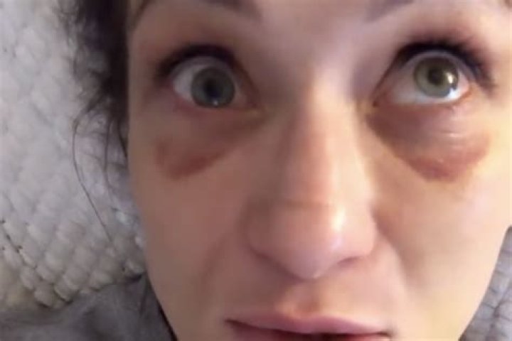 Karolina Kowalkiewicz Eye: A Closer Look At Her Traumatic Injury