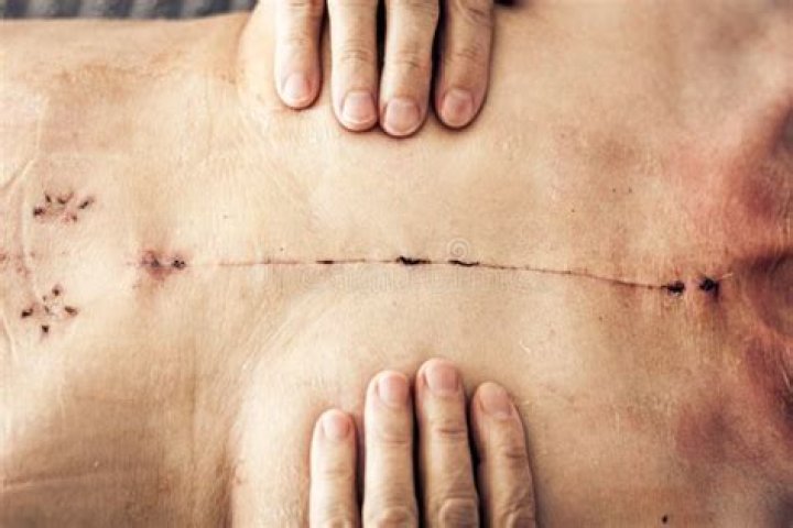 Understanding The Journey Of Healing: The Open Heart Surgery Scar