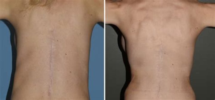 Transformations In Focus: Rib Removal Before After