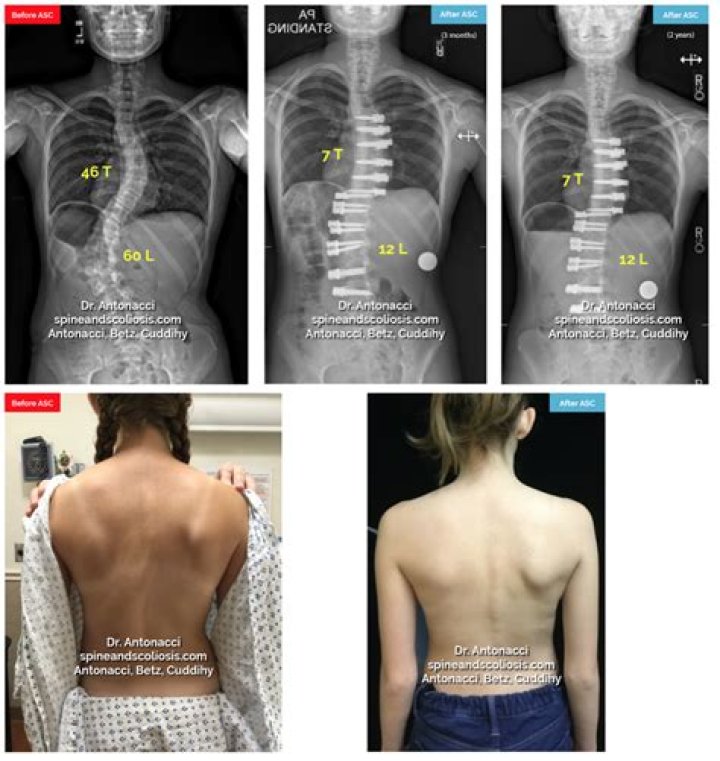 Understanding Scar Scoliosis Surgery: A Comprehensive Guide