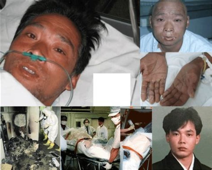 Unveiling The Tragic Reality: Hisashi Ouchi After Radiation Photos