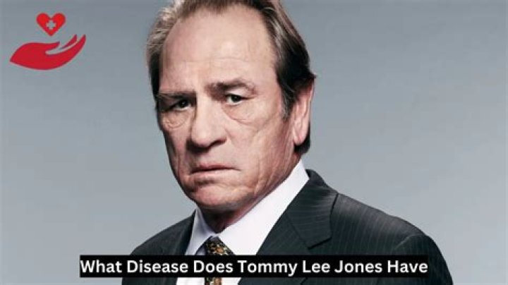 Unraveling The Mystery: What Disease Does Tommy Lee Jones Have?